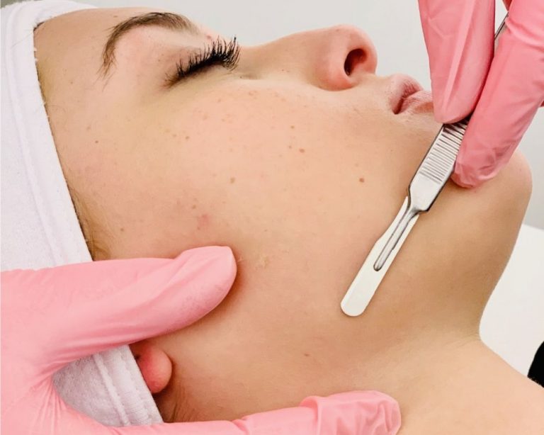 What is Dermaplaning?
