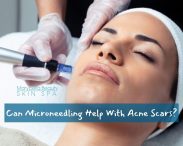 Can Microneedling Help With Acne Scars?
